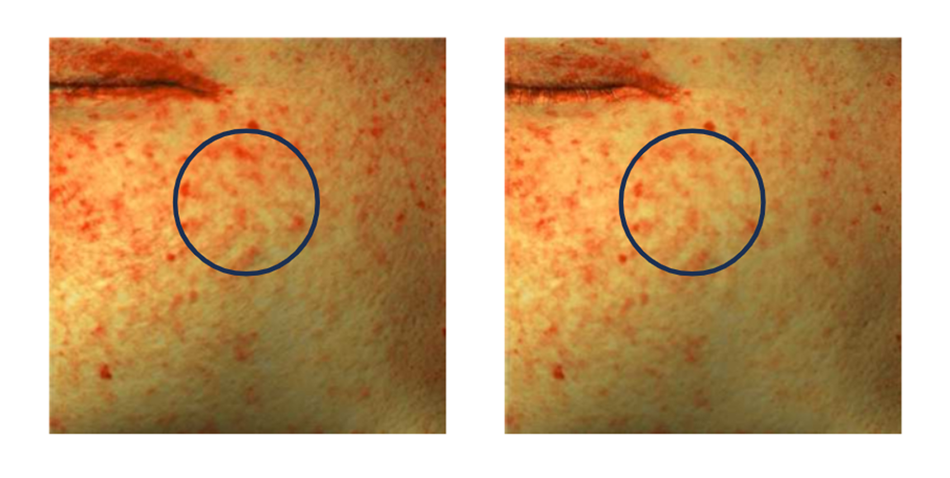 Improvement pigmentation area by 24.55% after 2 weeks of use