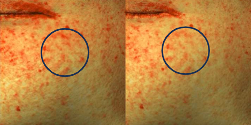 Improvement in pigmentation area by 24.55% after 2 weeks of use