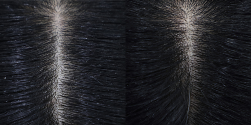 6.58% improvement in hair volume in the part of the hair after 4 weeks of use