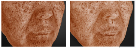 After 1 month of use, improved deep melanin pigment by 10%