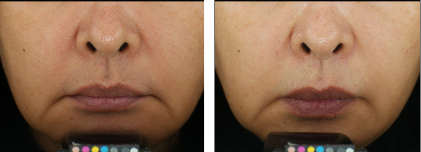 After 1 month of use, Improved skin tone