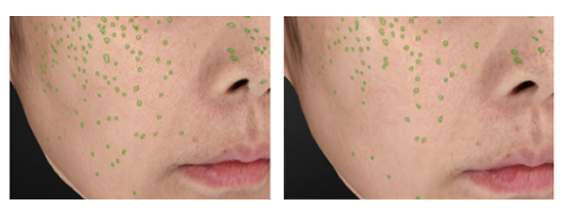 After 1 month of use, improved outer melanin pigment by 14%