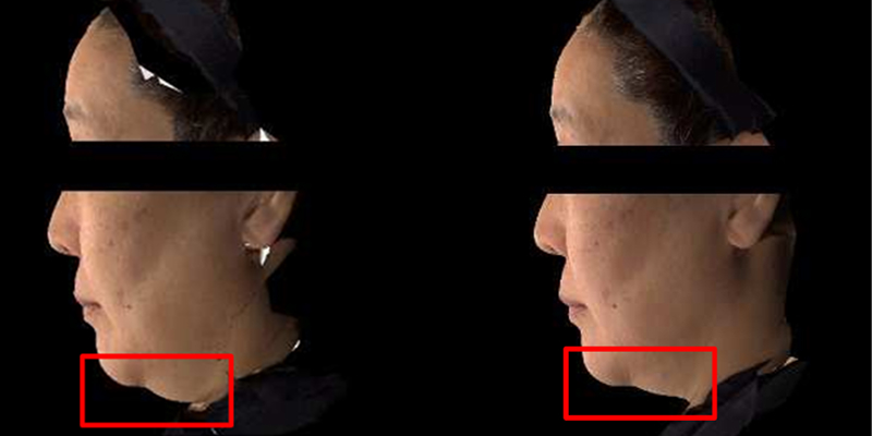 Improving double chin lifting by 9.28% after 2 weeks of use